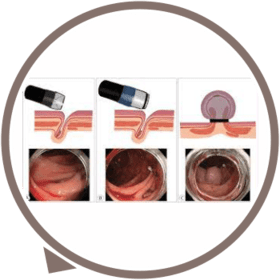 Endoscopic Hemostasis
