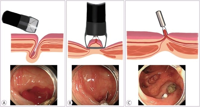 Endoscopic Hemostasis Treatment in Teynampet, Chennai