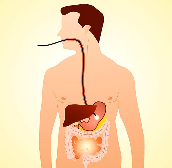 ERCP Procedure in Teynampet, Chennai