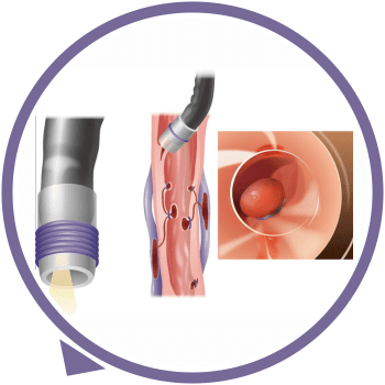 Endoscopic Variceal Ligation
