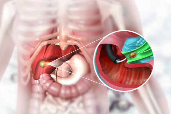 Gallbladder Disorders on the Rise: An Urban Digestive Health Crisis