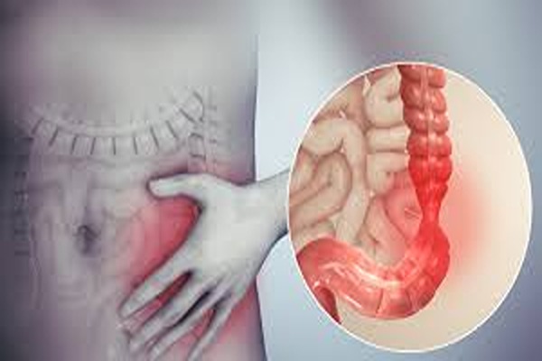 Irritable Bowel Syndrome (IBS) — Understanding the Modern Gut Disorder
