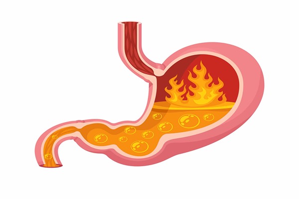 Knowing Acid Reflux: Why It Occurs and How to Manage It