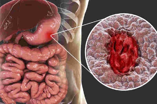 Understanding Stomach ulcers
